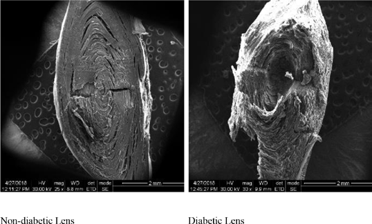 A Study of Diabetic and Non-diabetic Human Cataract Lens by Scanning Electron Microscopy