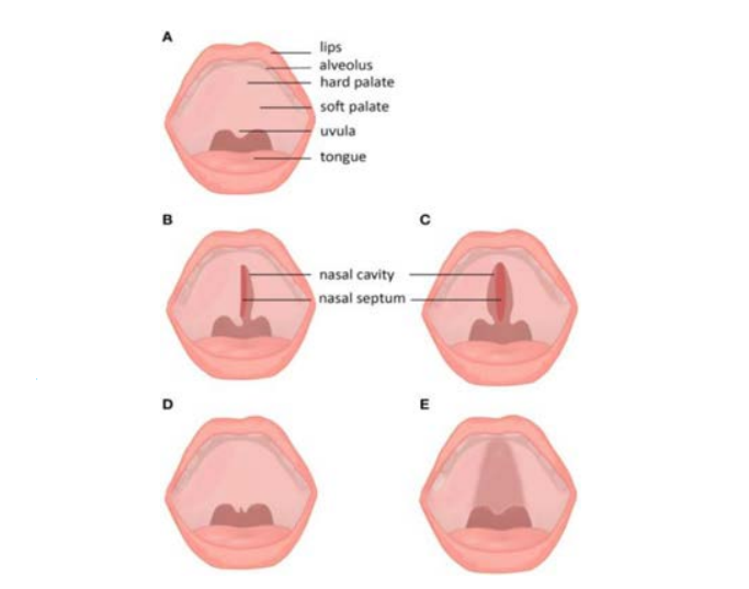 Cayler Syndrome with Isolated Cleft Palate: Case Report