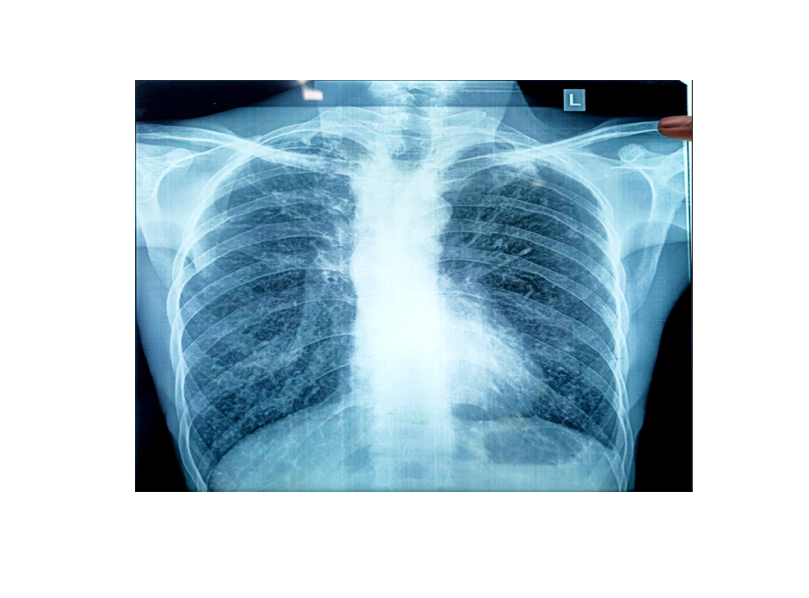 Tetralogy of Fallot in Adult – Uncorrected and Rare Presentation: A Case Report