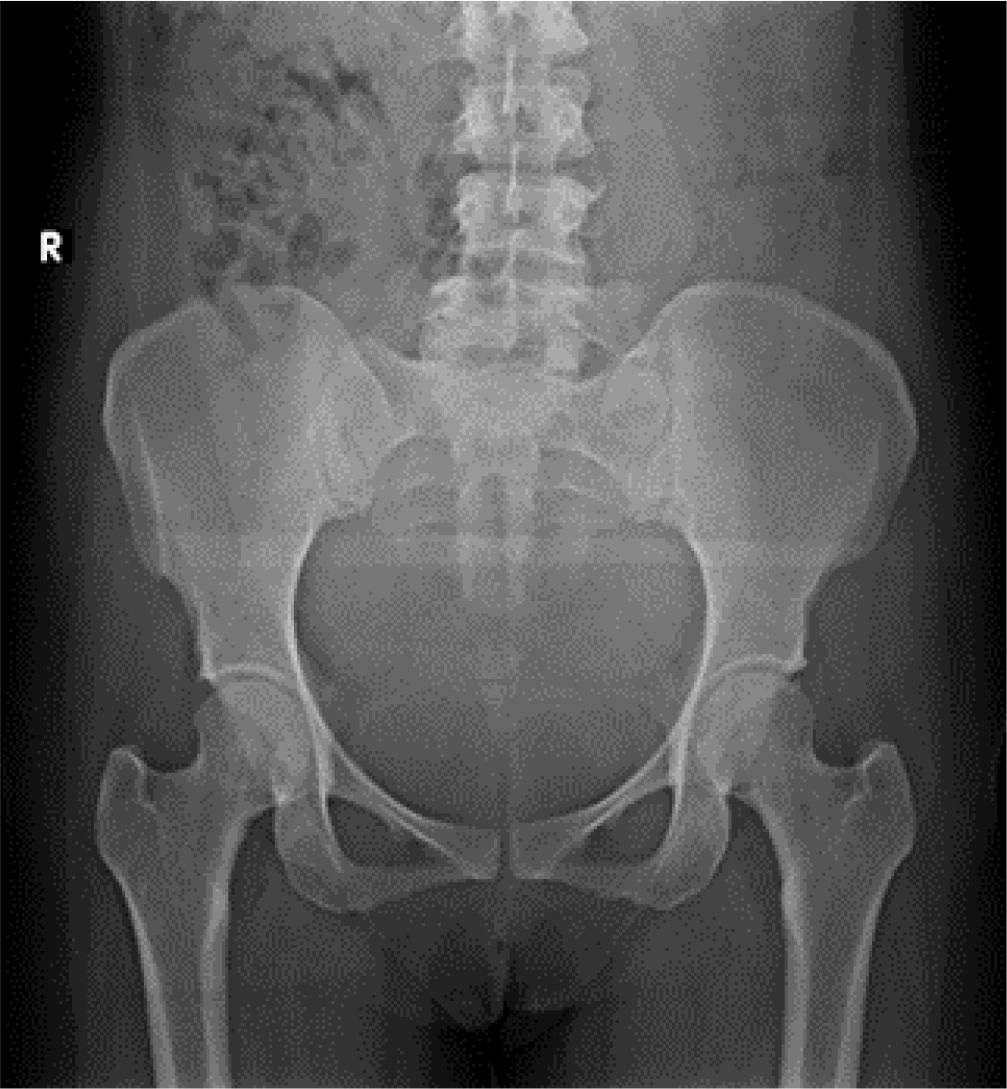Prevalence of Transitional Vertebrae in Etiopathogenesis of Low Back Ache among South Indian Population: A Cross-sectional Study