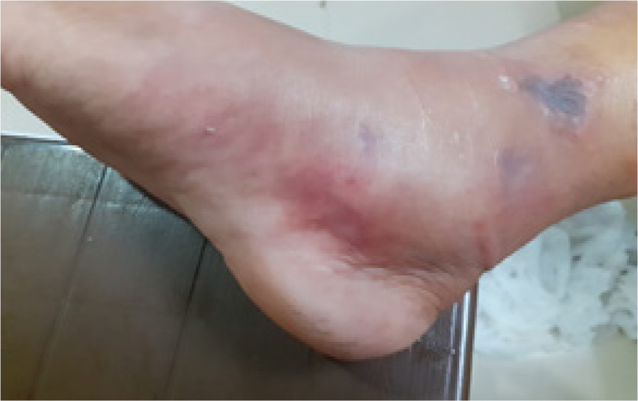 A Rare Case Report on Necrotizing Fasciitis with Compartment Syndrome of Right Leg
