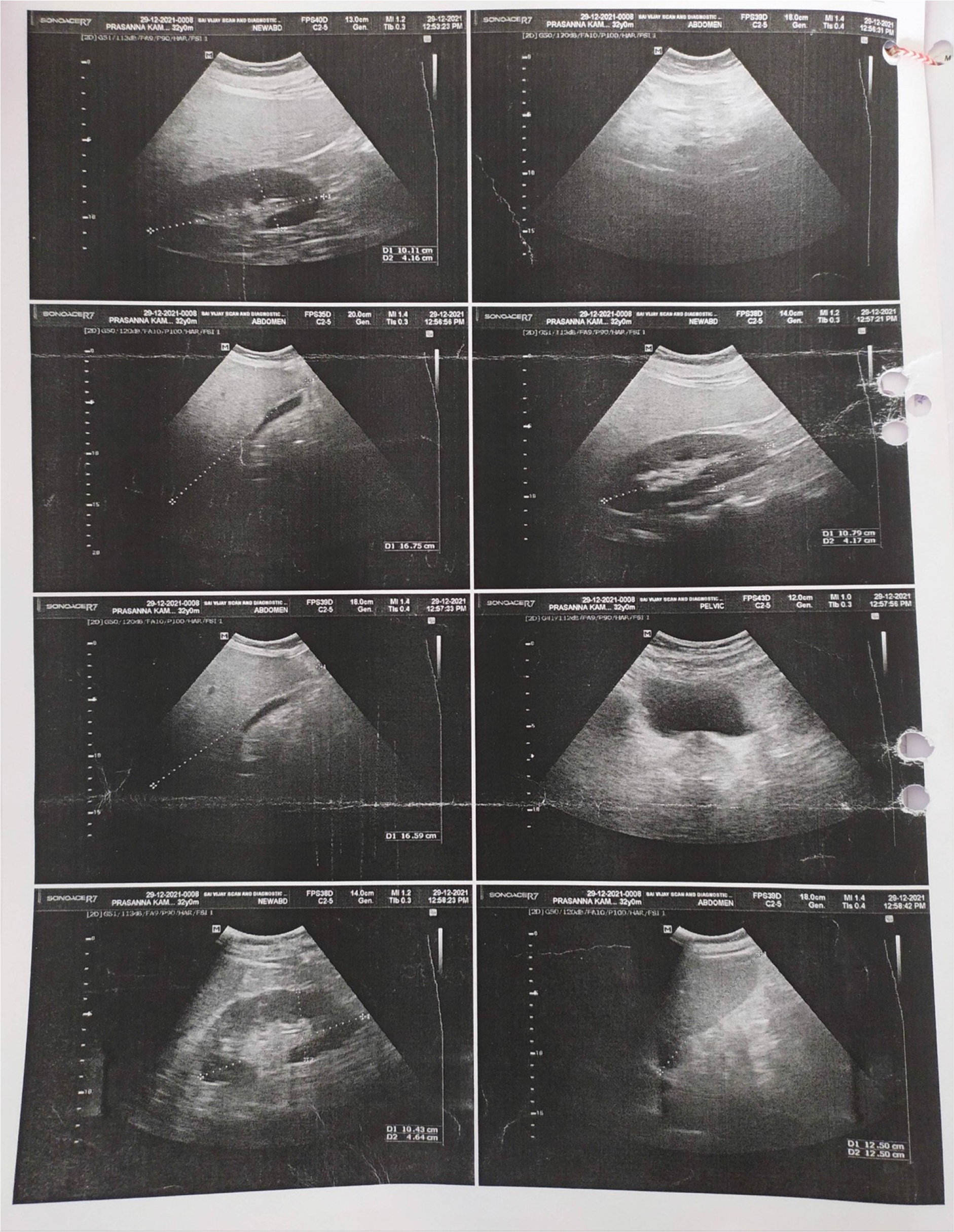 Anabolic Androgenic Steroids Induced Iatrogenic Cushing Syndrome in a Patient with Relapse of Antitubercular Drugs Induced Hepatitis