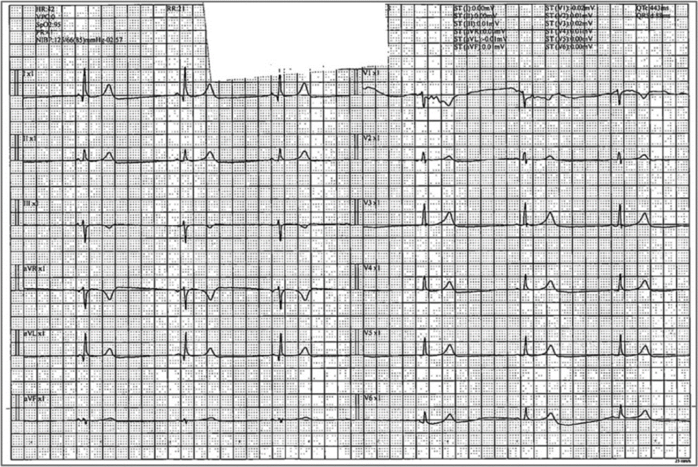 The Cardiotoxic Effects of Remdesivir Administered to the Patients with SARS-CoV Infection