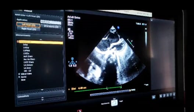 Ebstien Anomaly with Cardiomegaly in a Paediatric Patient: Case Report