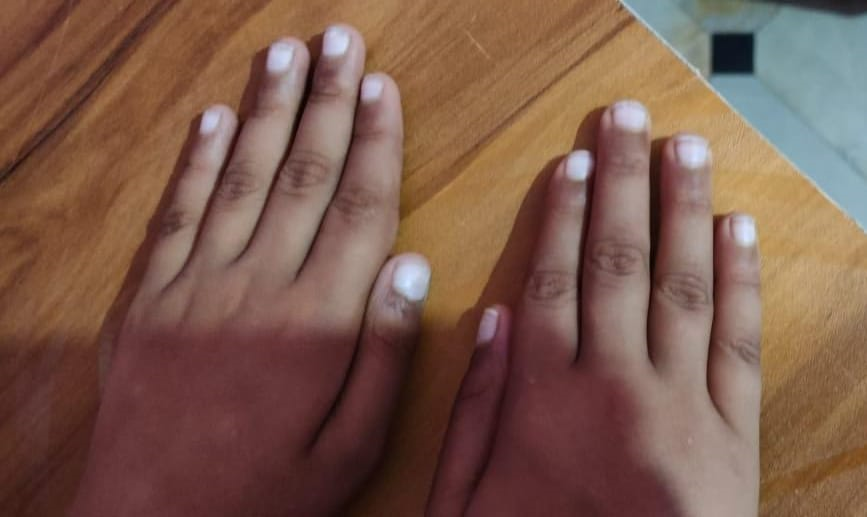 Transverse Leukonychia (Mees Lines) in Pediatric T-cell Acute Lymphoblastic Leukemia a Rare Manifestation During Combination Chemotherapy’s Maintenance Phase: A Case Report
