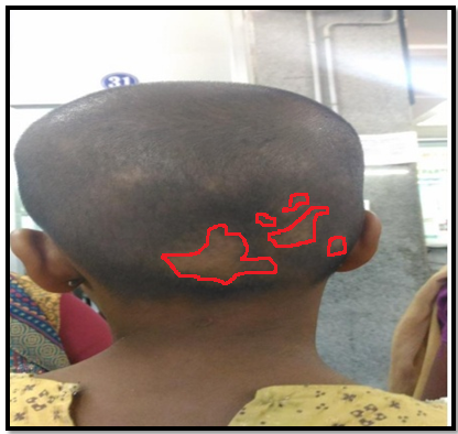Validation of Siddha Medicine in the Treatment of Alopecia areata in Paediatric Patient: A Case Report