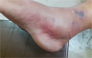 A Rare Case Report on Necrotizing Fasciitis with Compartment Syndrome of Right Leg