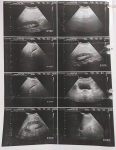 Anabolic Androgenic Steroids Induced Iatrogenic Cushing Syndrome in a Patient with Relapse of Antitubercular Drugs Induced Hepatitis