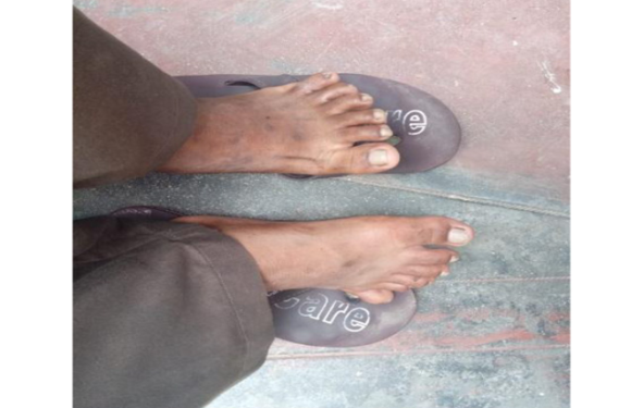 Laurence Moon Bardet Biedl Syndrome with Maturity Onset  Diabetes of the Young (Mody) – Case Report